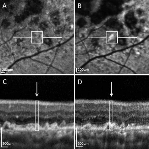 Imagen de angiografía fluoresceínica en fases tardías del ojo derecho