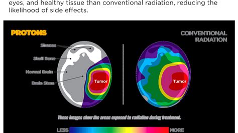 Side Effects Of Whole Brain Radiation - Effect Choices