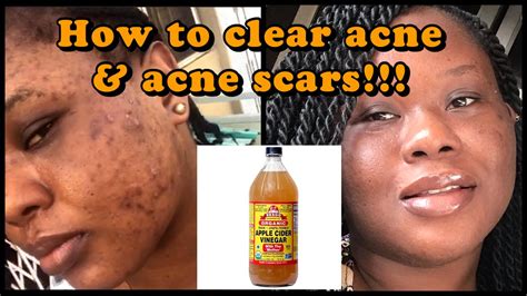 How To Clear Acne Scars With Apple Cider Vinegar This Amazing Tip