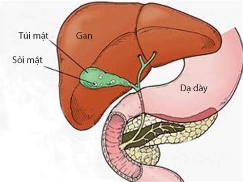 Những điều cần biết khi mổ sỏi mật BvNTP