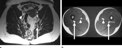 Mr Venography With True Fast Imaging With Steady State Precession For