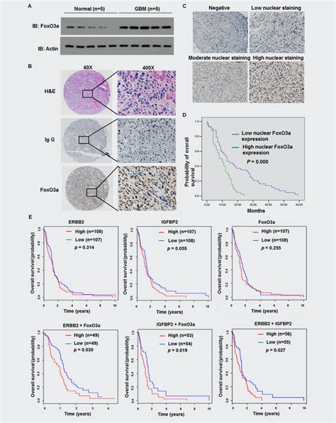 Overexpression Of Foxo A Is Associated With Glioblastoma Progression