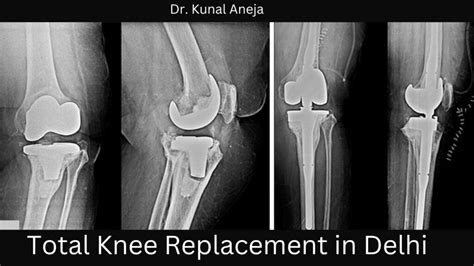 Best Knee Replacement Surgeon In Delhi Dr Kunal Aneja