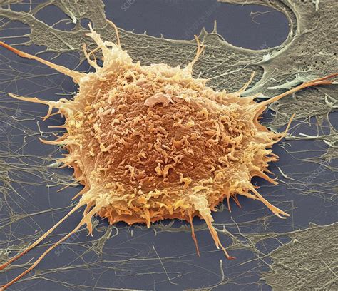 Cervical Cancer Cell SEM Stock Image C009 9187 Science Photo Library