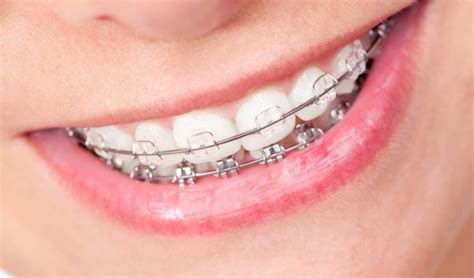 The Ultimate Guide To The Parts Of Braces Frey Orthodontics