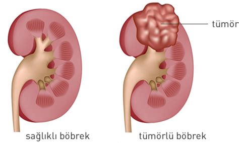 B Brek Kanseri Nedir Ve Belirtileri Op Dr Ali U Ur Zalp