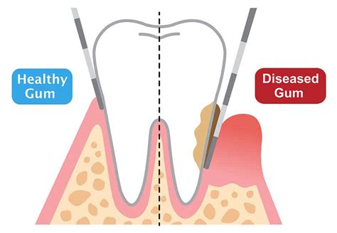 Dental Pocket Depth Chart At Karla Aiken Blog