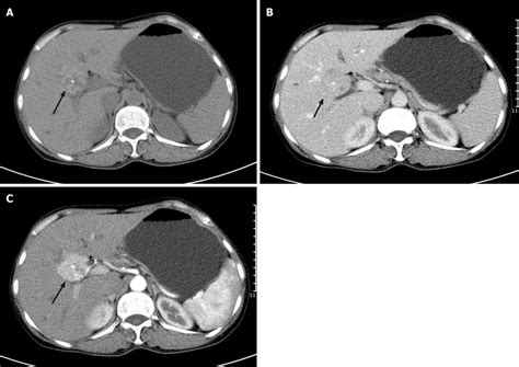 Abdominal Axial Computed Tomography Scan Findings A Non Enhanced