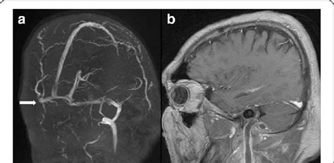 Mrv Image A No Flow In The Right Transverse And Sigmoid Sinus Also