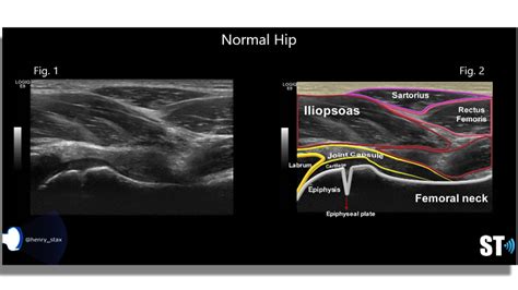 Hip Effusion – Sonographic Tendencies