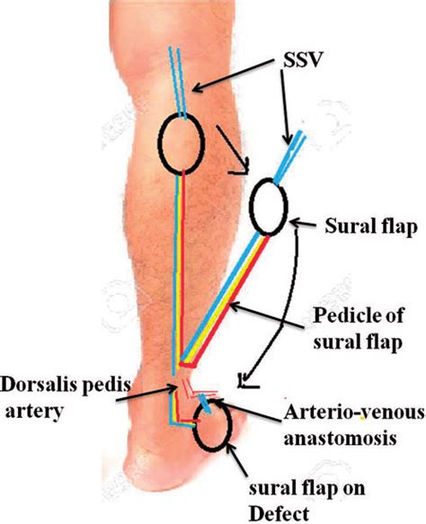 Diagrammatic Representation Of Arteriovenous Supercharged Distally Download Scientific Diagram