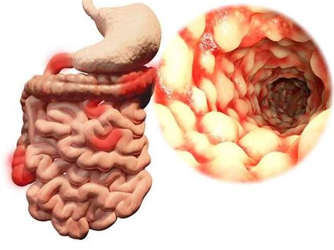 Penyakit Crohn Penyebab Gejala Diagnosis Dan Pengobatan