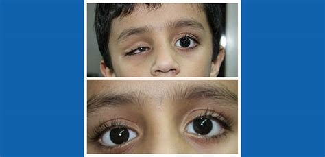 Oncular Prosthetics in Mumbai | Krishna Eye Center