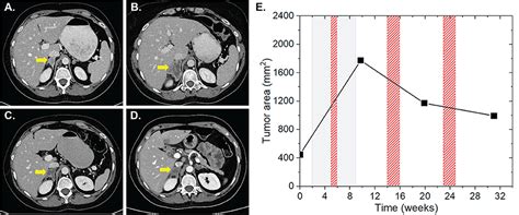 Frontiers Abscopal Effects In Radio Immunotherapyresponse Analysis