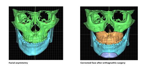 Facial Asymmetry Correction Surgery Effective In Relieving Jaw Joint