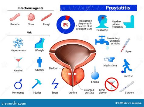 Prostatitis Benign Enlargement Of The Prostate Stock Vector Image