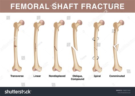 5,588 Femur fracture Images, Stock Photos & Vectors | Shutterstock