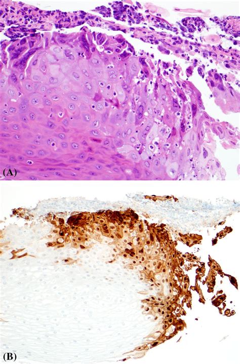 A Esophageal Biopsy Shows Herpes Esophagitis With Multinucleated Giant