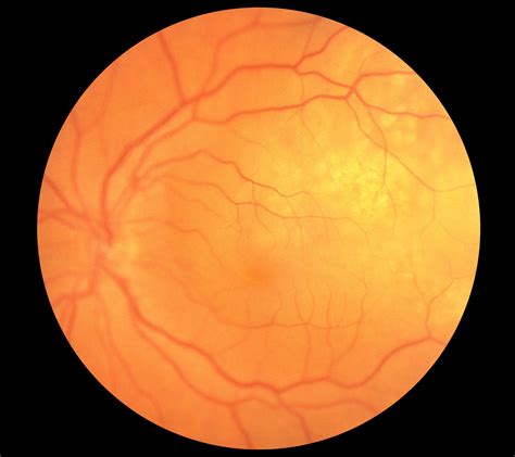 Choroidal Metastasis