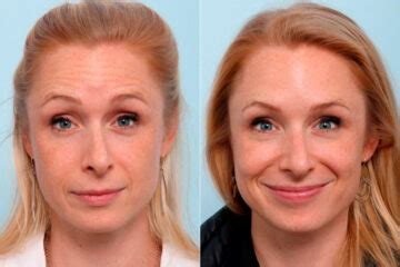 Botox Cosmetic Photos Houston Tx Patient