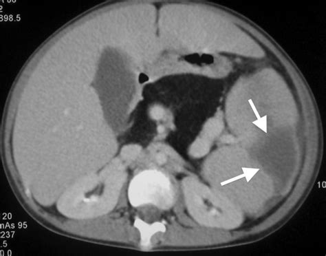 Contrast Enhanced Computed Tomography Ct Of Abdomen The Spleen Is Download Scientific