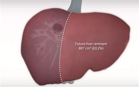 Laparoscopic Right Hepatectomy Tvasurg The Toronto Video Atlas Of Surgery