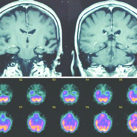 (A) Magnetic resonance imaging (MRI) showing atrophy of the left ...