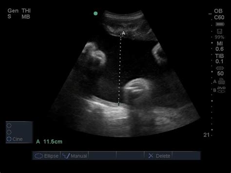 Normal Amniotic Fluid Virtboards