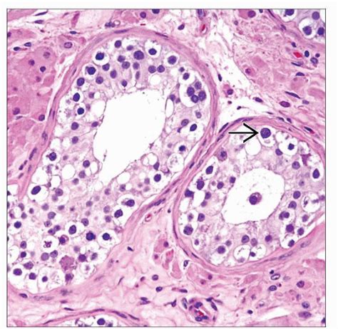 Intratubular Germ Cell Neoplasia | Basicmedical Key