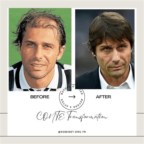 Antonio Conte Hair Transplant Is It Real