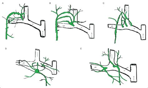 Thoracic Duct Anatomy At The Point Of Drainage A Normal Single Inlet Download Scientific