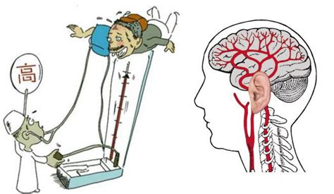 高血压的症状图片高血压图片大全高血压39疾病百科