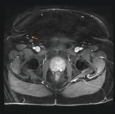 67 Year Old Male With Prostatic Stromal Tumor Of Uncertain Malignant