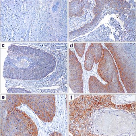 Histologic Grade In Penile Squamous Cell Carcinoma Scc A Grade 1 Scc Download Scientific