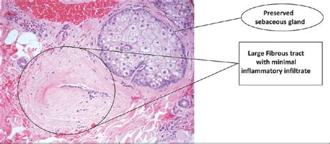 Scarring Alopecia Histology