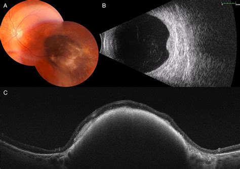 Multimodal Imaging In Choroidal Metastases A And B Color Fundus