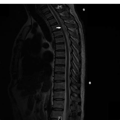 Mri Thoracic Spine Sagittal T Weighted Sequence A Close Up Of The