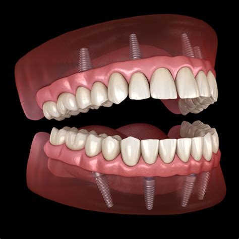 All-on-4 Dental Implants Scottsdale, AZ - Davis Dentistry