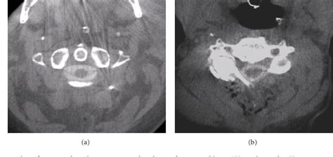 Figure 2 From Intraoperative Myelography In Cervical Multilevel