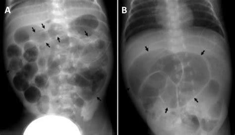 A Plain Abdominal Radiograph Taken At Hospital Day Shows Multiple