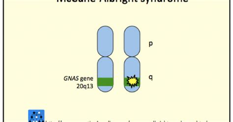 DermNet® - McCune Albright Syndrome image