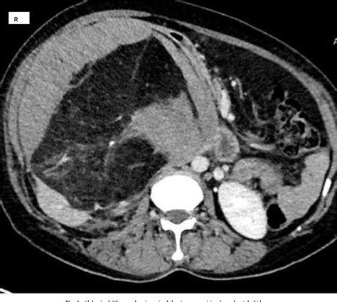 Figure 1 From Giant Renal Angiomyolipoma A Case Report Semantic Scholar