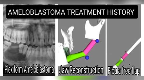 Plexiform ameloblastoma treatment history (Hindi)//Jaw reconstruction #ameloblastoma #free_flap ...