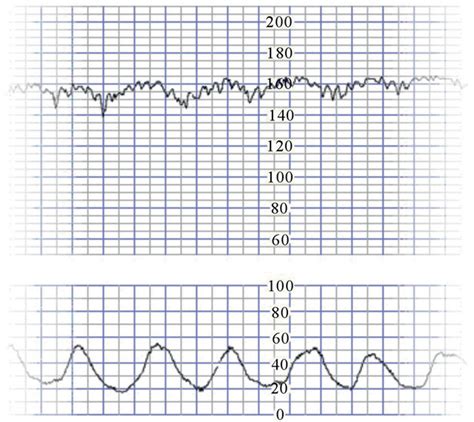 Interpretation Of British Experts’ Illustrations Of Fetal Heart Rate Fhr Decelerations By