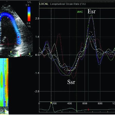 Radial And Circumferential Strain A Radial Strain Peak Systolic