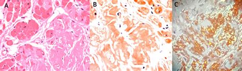 Histological Typing In Patients With Cardiac Amyloidosis Jacc Review