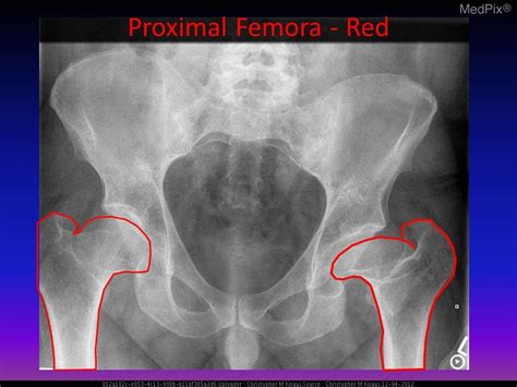 Congenital Hip Dysplasia Radiology