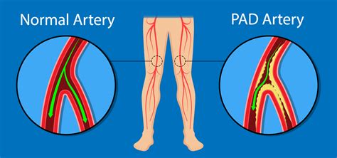 Peripheral Artery Disease Pad Advanced Vein Center