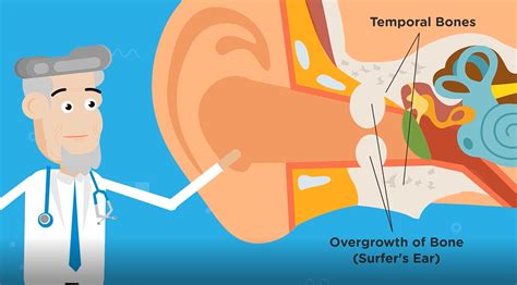 What Is Surfers Ear Infection? | KiteKahunas Surfers Ear Medical