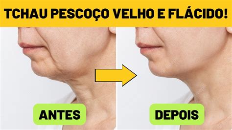 Diga Adeus Flacidez Do Pesco O Essas Receitas Naturais E